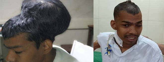 "World's largest brain tumor" removed