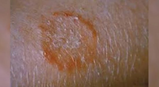 Fungal skin infection spreading in Anuradhapura