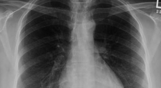 Acute lymphocytic interstitial pneumonitis – A potentially fatal complication in COVID-19
