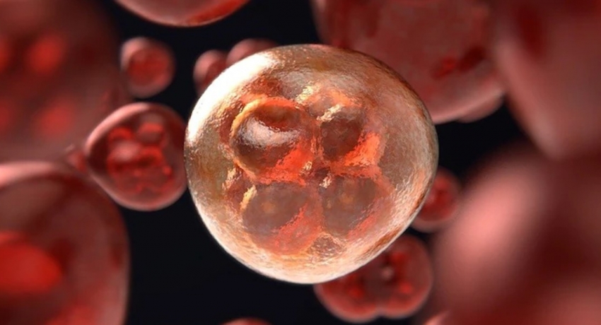 Woman reported cured of HIV after bone marrow transplant