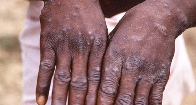 Monkeypox ‘could’ enter SL, warn health officials
