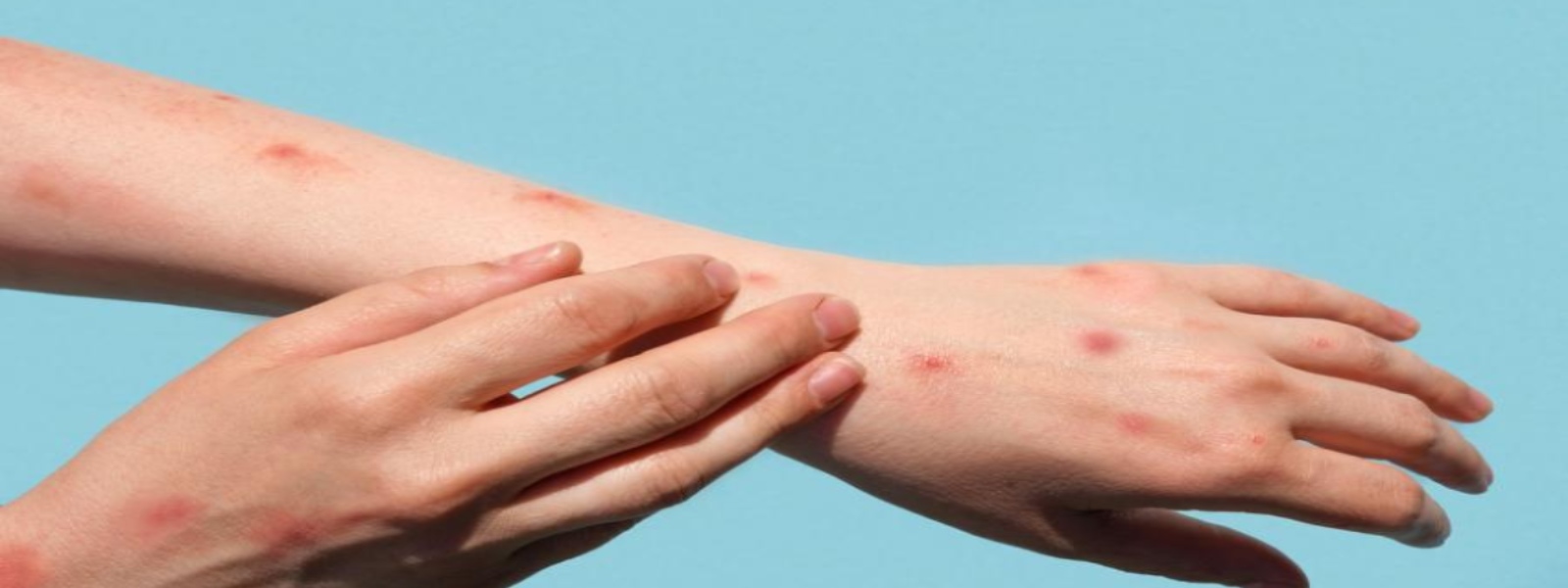 UK funds to develop standard monkeypox tools