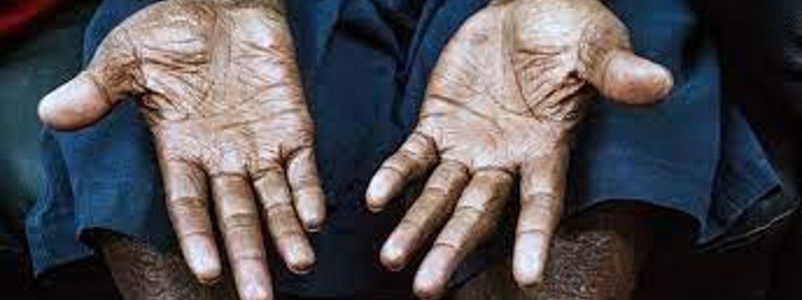350+ leprosy patients reported in 2022