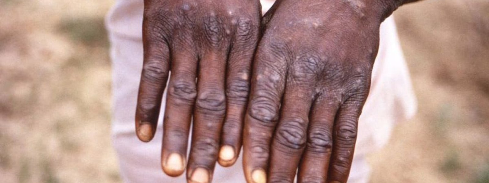 Health sector assures it is prepared for monkeypox testing