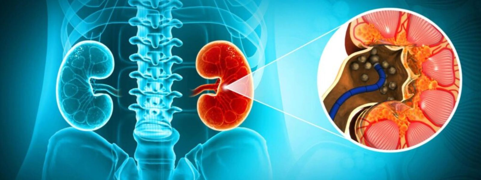 5,000+ Patients for Kidney Stone Removal Surgeries