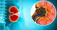 5,000+ Patients for Kidney Stone Removal Surgeries