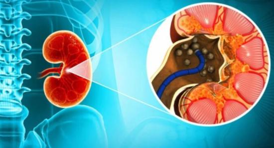 5,000+ Patients for Kidney Stone Removal Surgeries