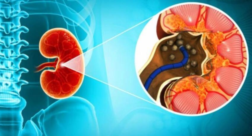 5,000+ Patients for Kidney Stone Removal Surgeries
