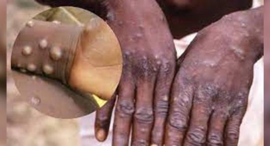 ඉන්දියාවෙන් පළමු මන්කිපොක්ස් මරණය වාර්තා වෙයි