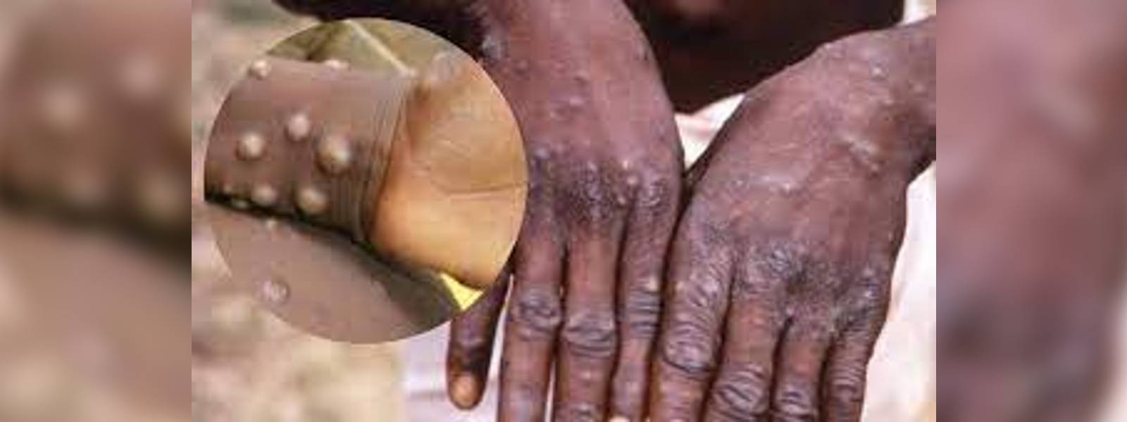 ඉන්දියාවෙන් පළමු මන්කිපොක්ස් මරණය වාර්තා වෙයි