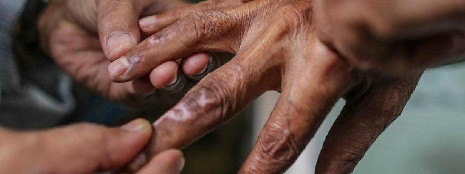 15 வயதுக்குட்பட்ட சிறுவர்களிடையே பரவும் தொழுநோய்