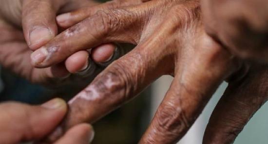 15 வயதுக்குட்பட்ட சிறுவர்களிடையே பரவும் தொழுநோய்